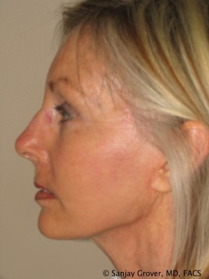 Facelift Before and After 28 | Sanjay Grover MD FACS