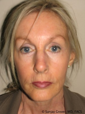 Facelift Before and After 28 | Grover Aesthetics