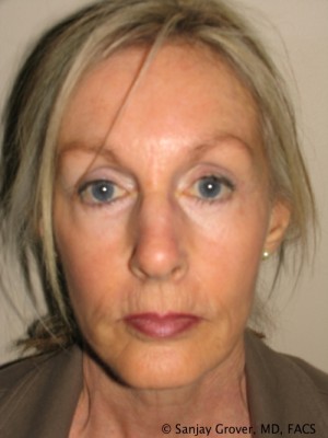 Facelift Before and After 28 | Sanjay Grover MD FACS