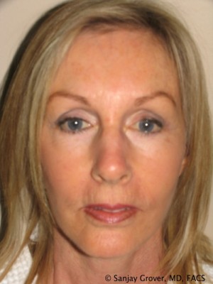 Facelift Before and After 28 | Sanjay Grover MD FACS