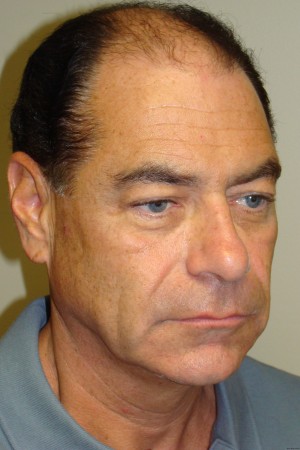 Facelift Before and After | Grover Aesthetics