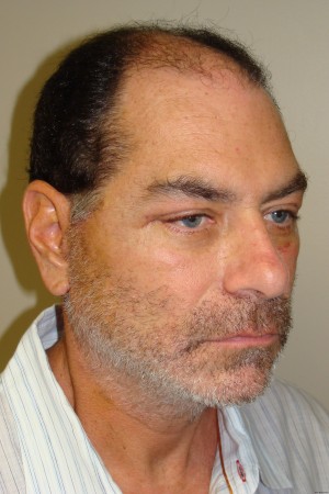 Facelift Before and After | Grover Aesthetics