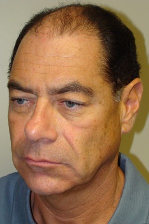 Facelift Before and After 29 | Grover Aesthetics