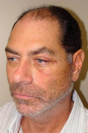 Facelift Before and After 29 | Grover Aesthetics