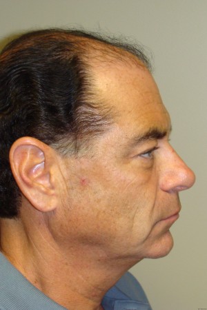 Facelift Before and After 29 | Grover Aesthetics