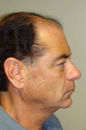 Facelift Before and After 29 | Sanjay Grover MD FACS