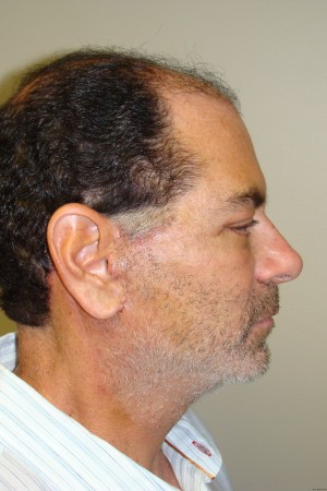 Facelift Before and After 29 | Sanjay Grover MD FACS