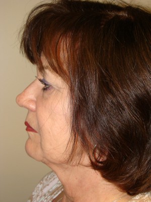 Facelift Before and After 29 | Sanjay Grover MD FACS