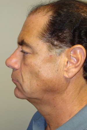 Facelift Before and After 29 | Sanjay Grover MD FACS