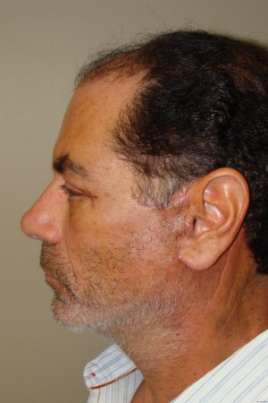 Facelift Before and After 29 | Sanjay Grover MD FACS