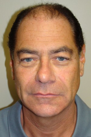 Facelift Before and After 29 | Grover Aesthetics