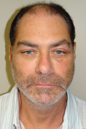 Facelift Before and After 29 | Grover Aesthetics