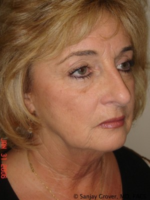 Facelift Before and After 09 | Sanjay Grover MD FACS