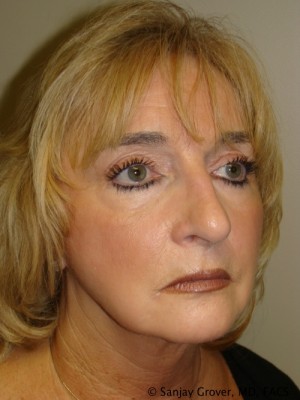 Facelift Before and After 30 | Sanjay Grover MD FACS