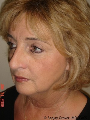 Facelift Before and After 30 | Sanjay Grover MD FACS