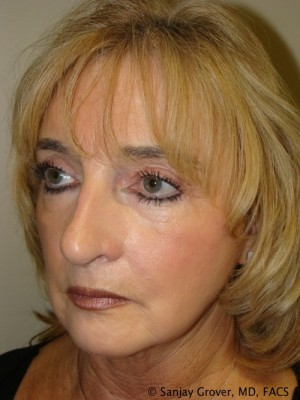 Facelift Before and After 30 | Grover Aesthetics