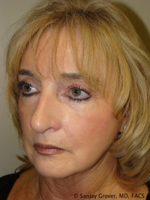 Facelift Before and After 30 | Sanjay Grover MD FACS