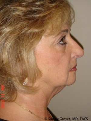 Facelift Before and After 30 | Grover Aesthetics