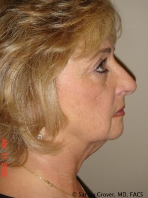 Facelift Before and After 30 | Sanjay Grover MD FACS