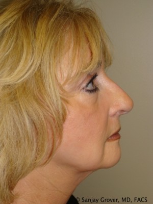 Facelift Before and After 30 | Sanjay Grover MD FACS