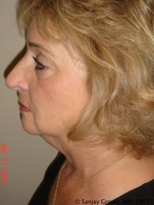 Facelift Before and After 30 | Sanjay Grover MD FACS