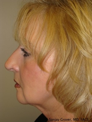 Facelift Before and After 30 | Grover Aesthetics