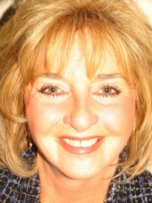 Facelift Before and After 30 | Grover Aesthetics