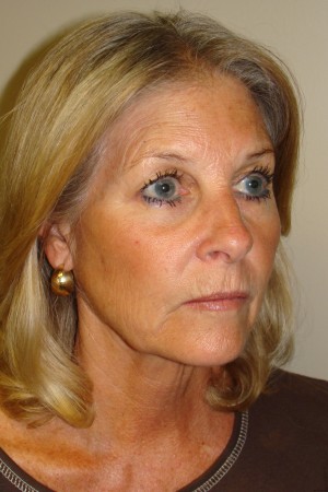 Facelift Before and After | Grover Aesthetics