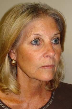 Facelift Before and After 33 | Sanjay Grover MD FACS