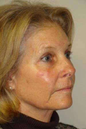 Facelift Before and After 31 | Sanjay Grover MD FACS