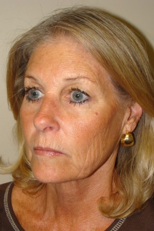 Facelift Before and After 31 | Sanjay Grover MD FACS