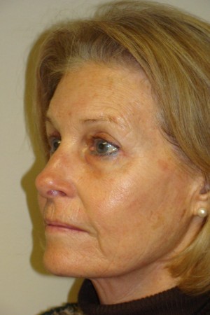 Facelift Before and After 31 | Sanjay Grover MD FACS