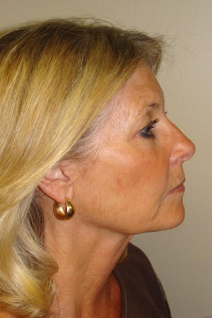 Facelift Before and After 31 | Sanjay Grover MD FACS