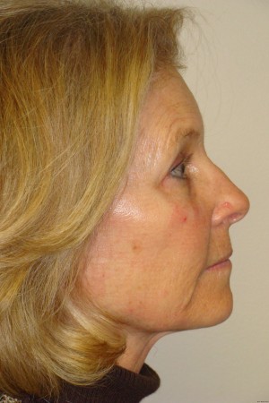 Facelift Before and After 31 | Sanjay Grover MD FACS