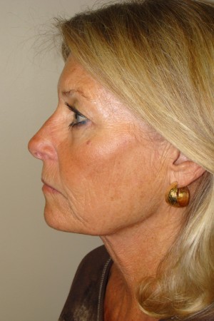 Facelift Before and After 31 | Sanjay Grover MD FACS