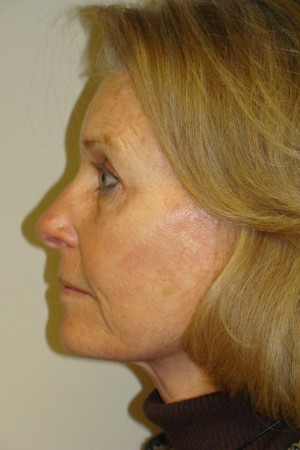 Facelift Before and After 31 | Grover Aesthetics