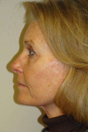 Facelift Before and After 31 | Sanjay Grover MD FACS