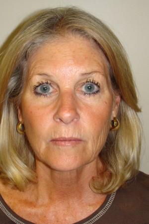 Facelift Before and After 31 | Sanjay Grover MD FACS