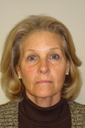 Facelift Before and After 31 | Grover Aesthetics