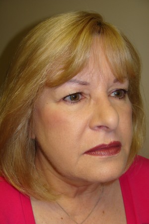 Facelift Before and After | Grover Aesthetics