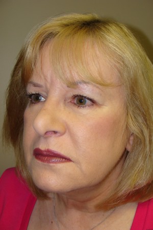 Facelift Before and After 32 | Grover Aesthetics