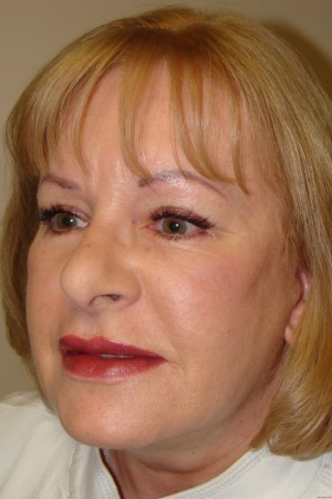 Facelift Before and After 32 | Grover Aesthetics