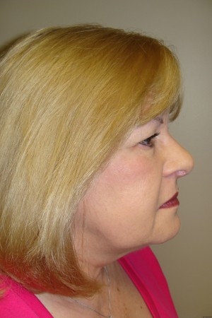Facelift Before and After 32 | Grover Aesthetics