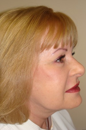 Facelift Before and After 32 | Grover Aesthetics