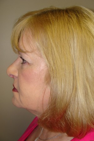Facelift Before and After 32 | Grover Aesthetics