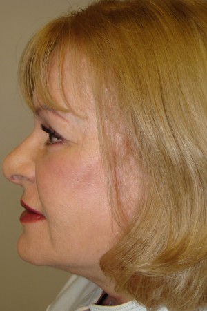 Facelift Before and After 32 | Grover Aesthetics