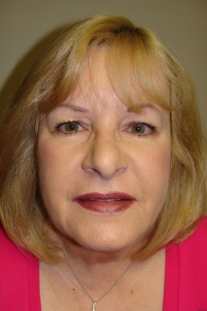Facelift Before and After 32 | Grover Aesthetics