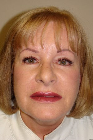 Facelift Before and After 32 | Grover Aesthetics