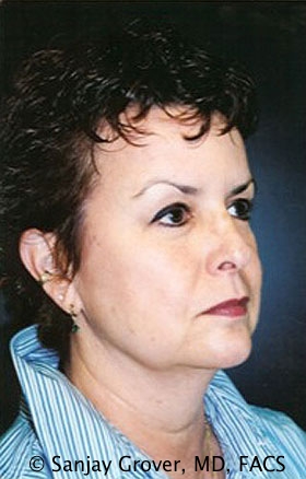 Facelift Before and After | Grover Aesthetics