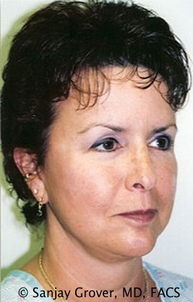 Facelift Before and After | Grover Aesthetics
